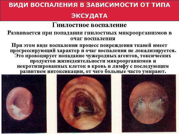 ВИДИ ВОСПАЛЕНИЯ В ЗАВИСИМОСТИ ОТ ТИПА ЭКСУДАТА Гнилостное воспаление Развивается при попадании гнилостных микроорганизмов