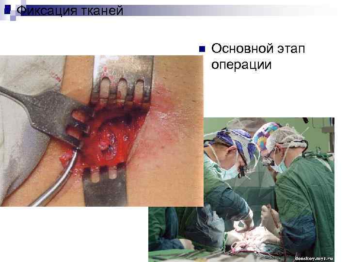 n Фиксация тканей n Основной этап операции 