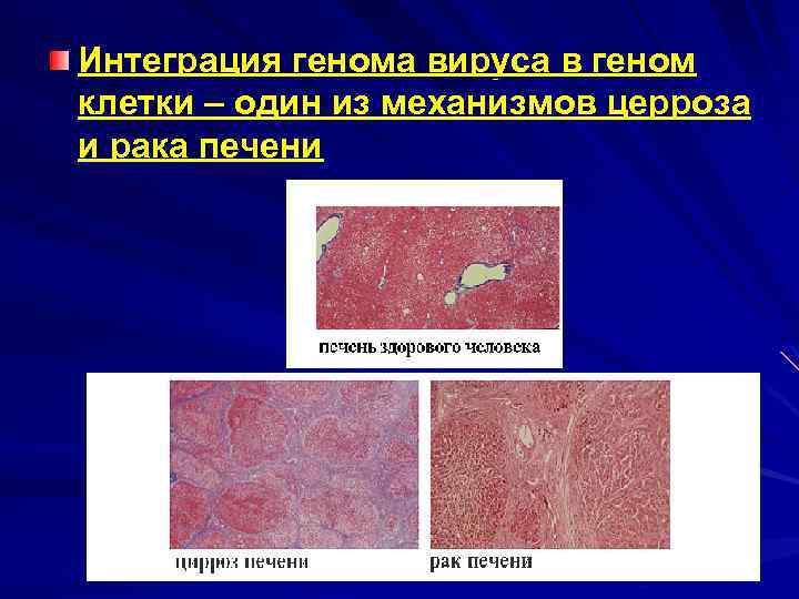 Интеграция генома вируса в геном клетки – один из механизмов церроза и рака печени