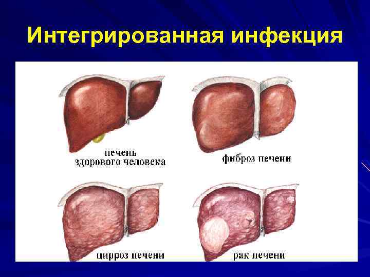 Интегрированная инфекция 