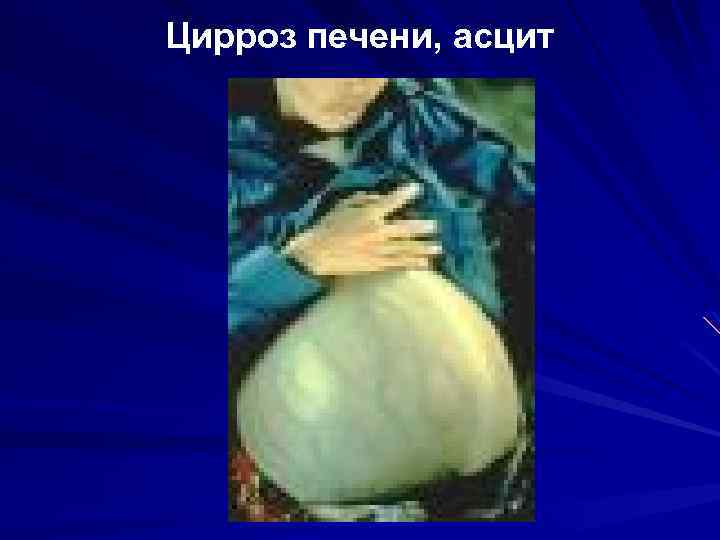 Цирроз печени, асцит 