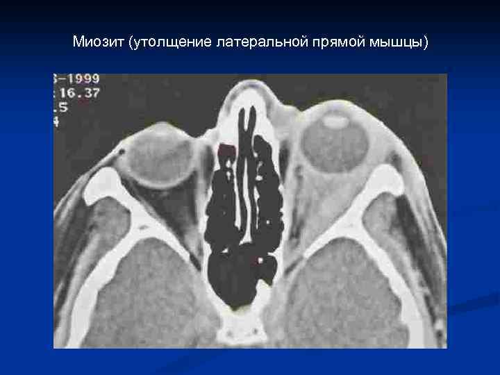 Миозит (утолщение латеральной прямой мышцы) 
