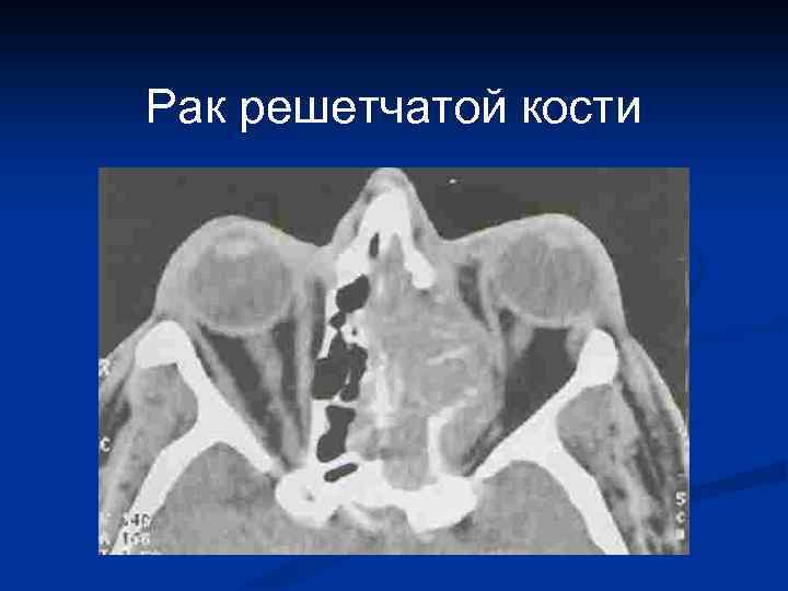 Рак костей симптомы анализ