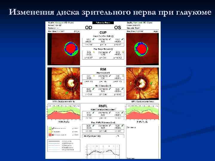 Норма зрительного нерва. Экскавация диска зрительного нерва норма. Глаукоматозная экскавация диска зрительного нерва окт. ОСТ диска зрительного нерва в норме. ОСТ ДЗН норма и расшифровка.
