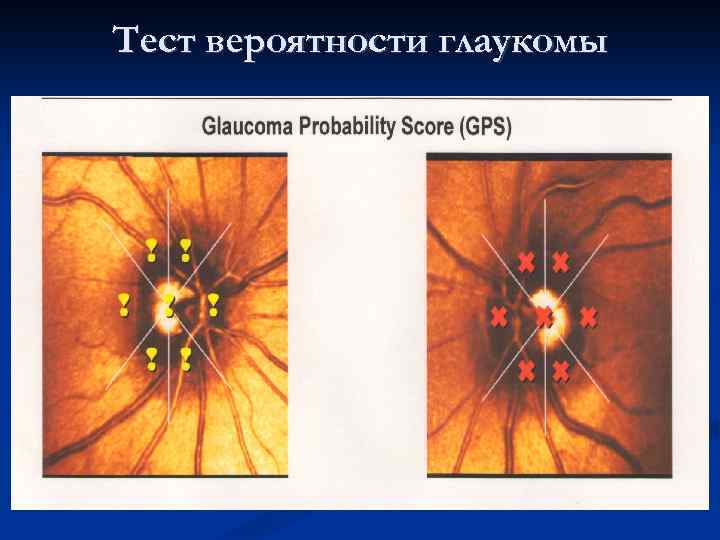 Тест вероятности глаукомы 