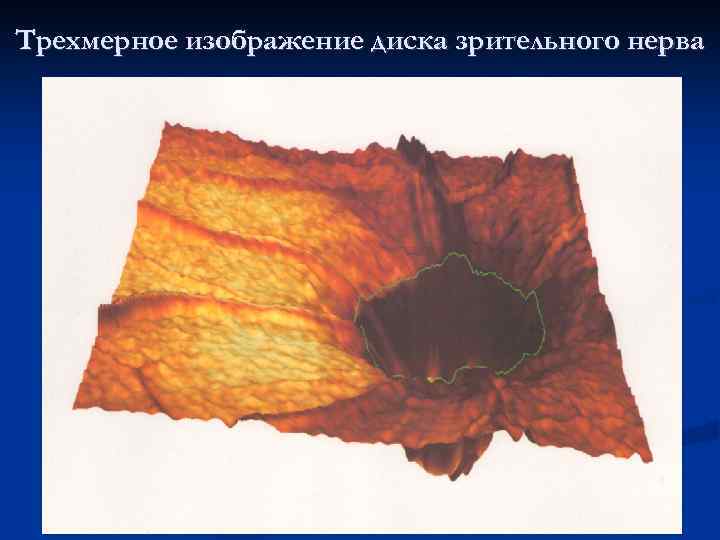 Трехмерное изображение диска зрительного нерва 