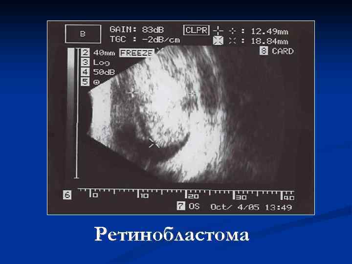 Ретинобластома 