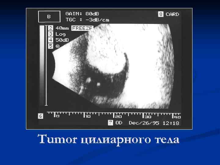 Tumor цилиарного тела 