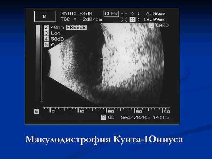 Макулодистрофия Кунта-Юниуса 