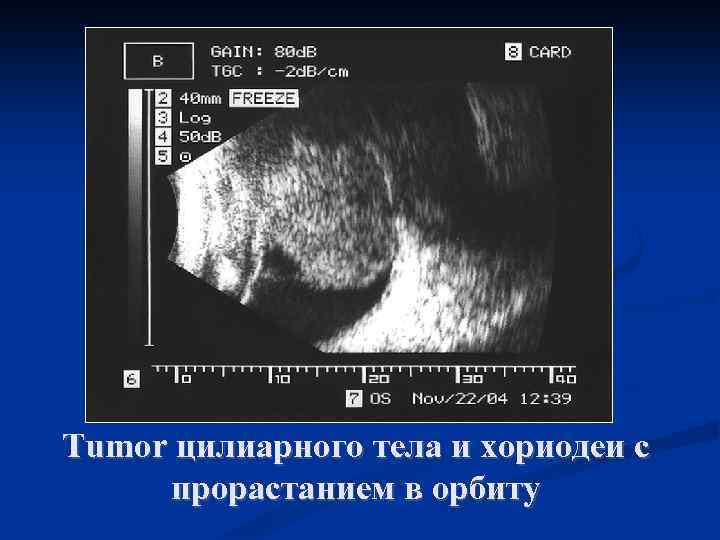 Tumor цилиарного тела и хориодеи с прорастанием в орбиту 