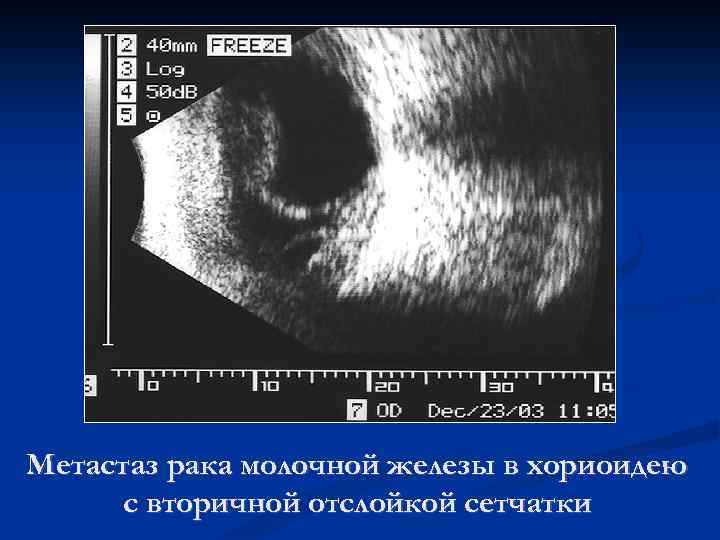 Метастаз рака молочной железы в хориоидею с вторичной отслойкой сетчатки 