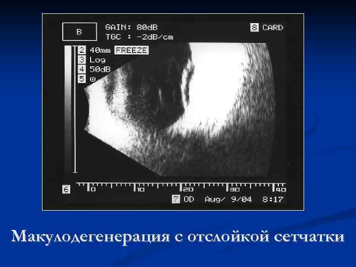 Макулодегенерация с отслойкой сетчатки 