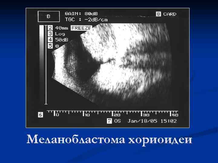 Меланобластома хориоидеи 