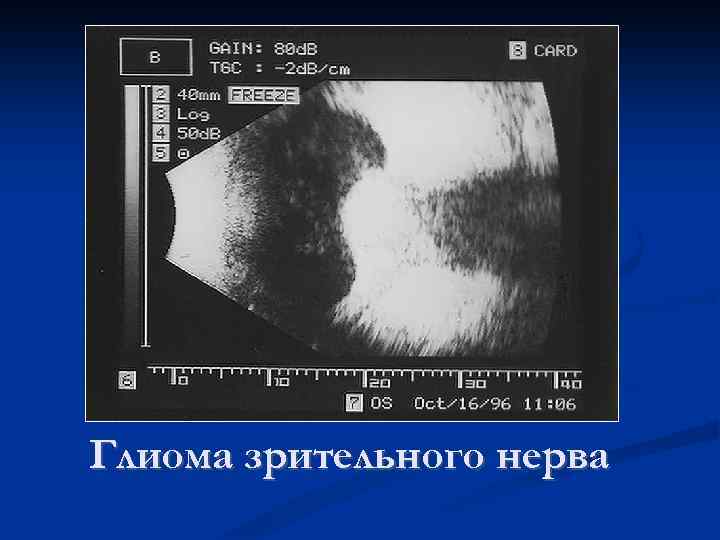 Глиома зрительного нерва 