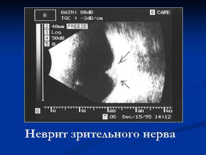 Неврит зрительного нерва 