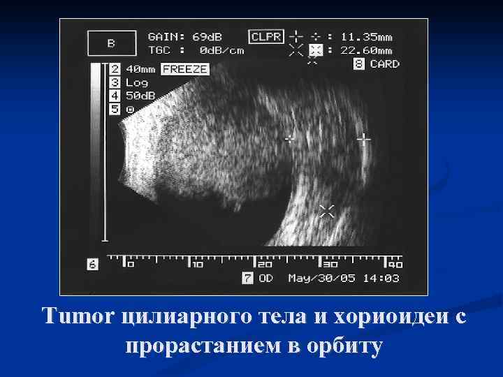 Tumor цилиарного тела и хориоидеи с прорастанием в орбиту 