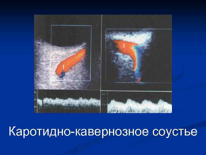 Каротидно-кавернозное соустье 