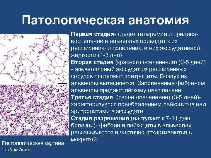 Патологическая анатомия Гистологическая картина пневмонии. Первая стадия- стадия гиперемии и приливавоспаление в альвеолах приводит