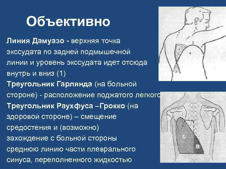Объективно Линия Дамуазо - верхняя точка экссудата по задней подмышечной линии и уровень экссудата