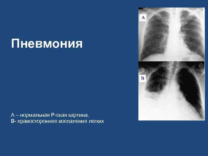 Пневмония А – нормальная Р-ская картина, В- правостороннее воспаление легких 