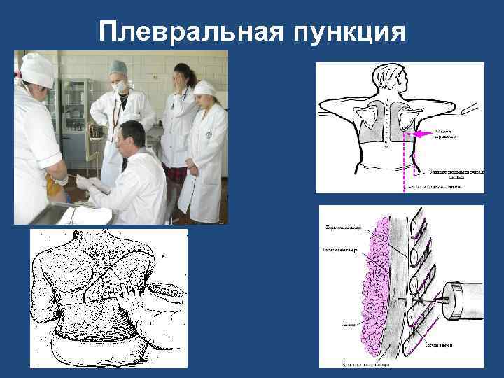Плевральная пункция 