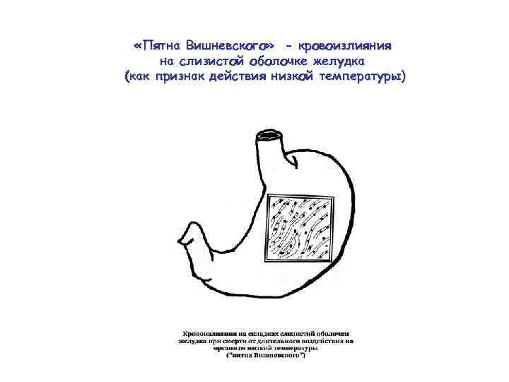  «Пятна Вишневского» - кровоизлияния на слизистой оболочке желудка (как признак действия низкой температуры)