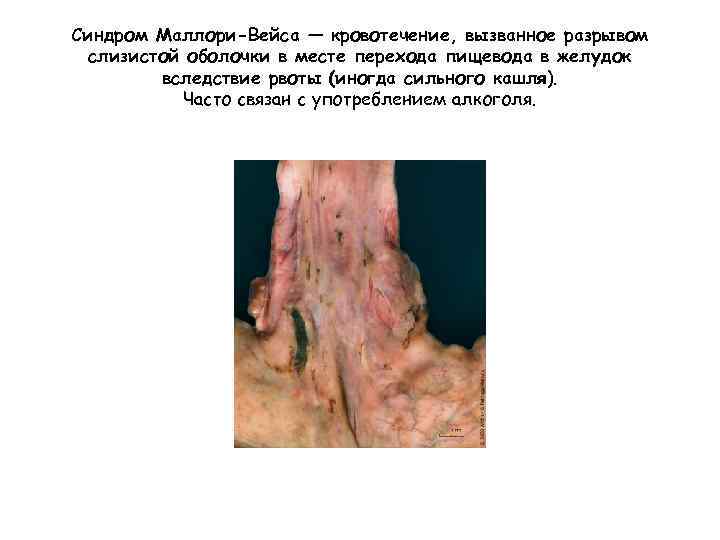 Синдром Маллори-Вейса — кровотечение, вызванное разрывом слизистой оболочки в месте перехода пищевода в желудок