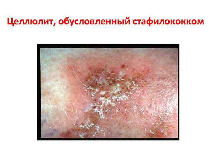 Целлюлит, обусловленный стафилококком 