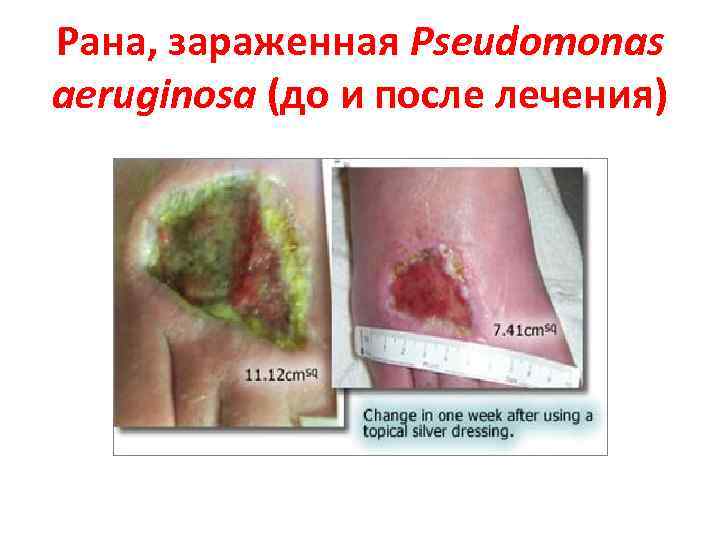 Рана, зараженная Pseudomonas aeruginosa (до и после лечения) 