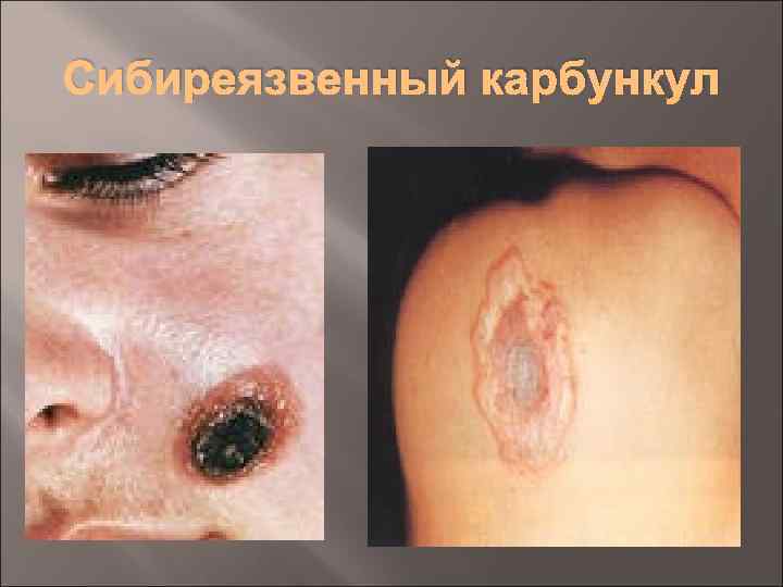 Сибиреязвенный карбункул 