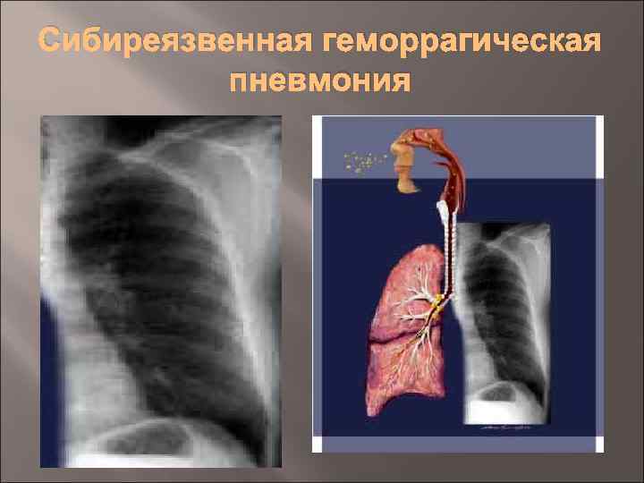 Сибиреязвенная геморрагическая пневмония 