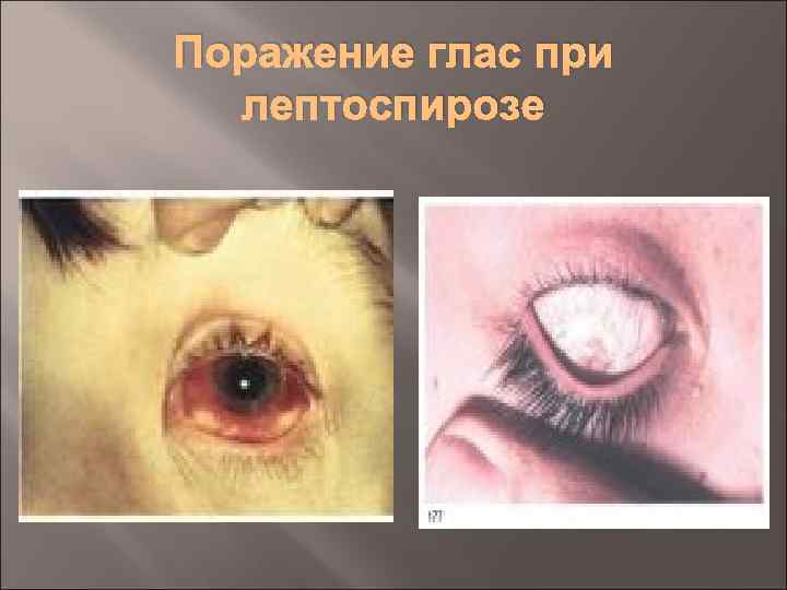 Поражение глас при лептоспирозе 