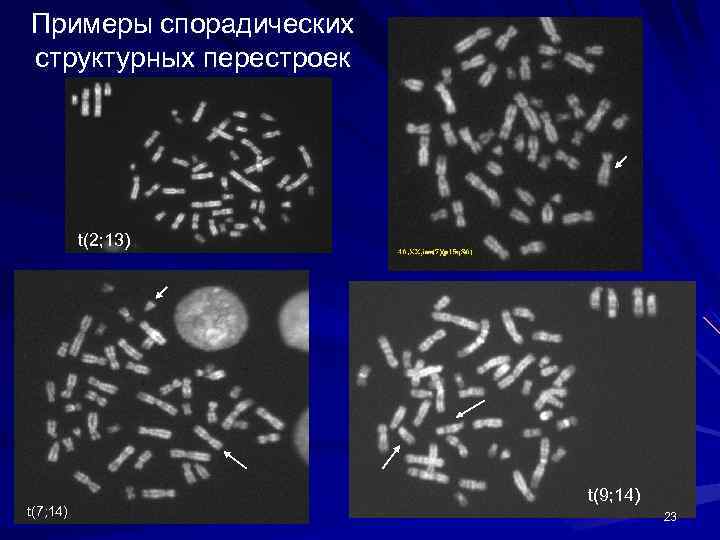 Примеры спорадических структурных перестроек t(2; 13) t(7; 14) t(9; 14) 23 