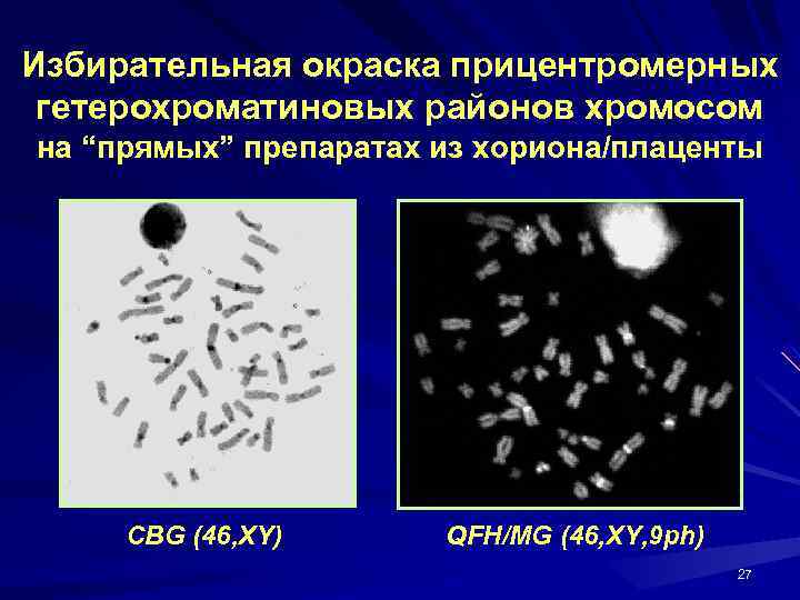 Избирательная окраска прицентромерных гетерохроматиновых районов хромосом на “прямых” препаратах из хориона/плаценты CBG (46, XY)
