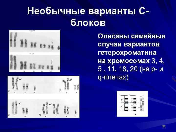 Необычные варианты Сблоков Описаны семейные случаи вариантов гетерохроматина на хромосомах 3, 4, 5 ,