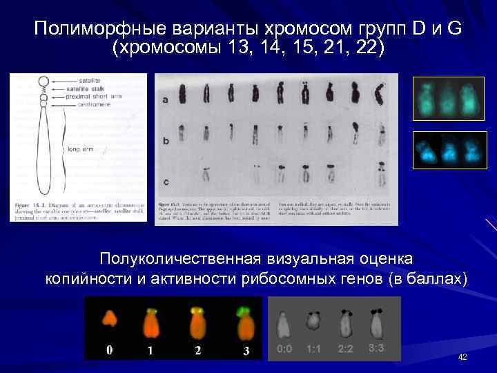 Хромосом группы d. Транслокация по 13 хромосоме. Полиморфная в хромосоме.