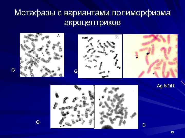 Метафазы с вариантами полиморфизма акроцентриков G G Ag-NOR G C 43 