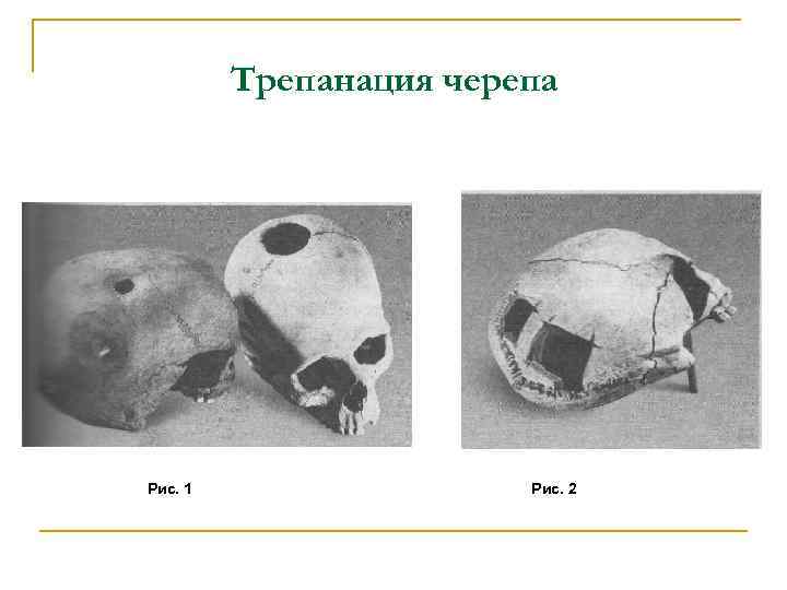 Трепанация черепа Рис. 1 Рис. 2 