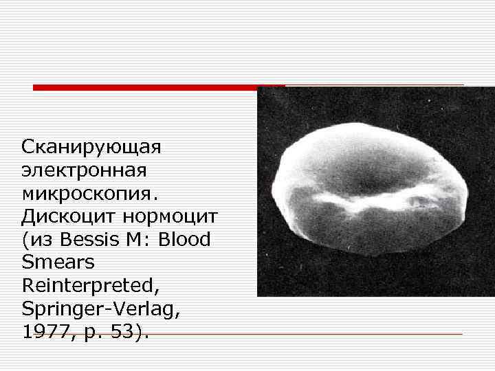 Сканирующая электронная микроскопия. Дискоцит нормоцит (из Bessis M: Blood Smears Reinterpreted, Springer-Verlag, 1977, p.