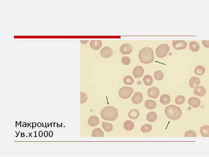 Макроциты. Нормоциты и макроциты. Макроциты мегалоциты тельца Жолли. Макроциты анемия. Анизоцитоз нормоциты микроциты макроциты.