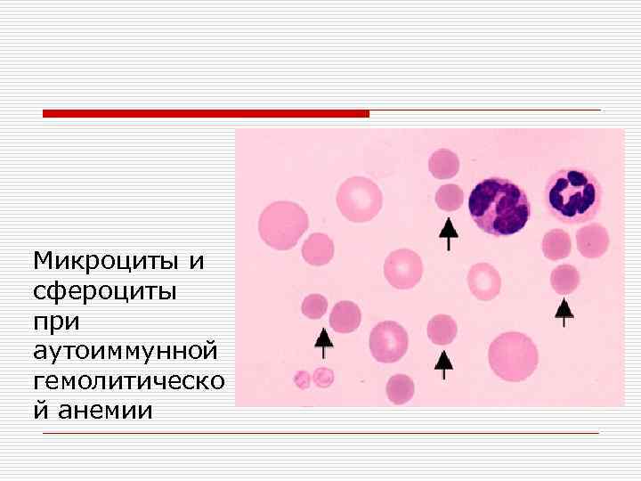 Микроциты повышены у женщины