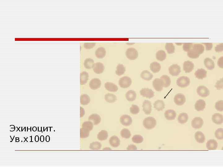 Эхиноцит. Ув. х1000 
