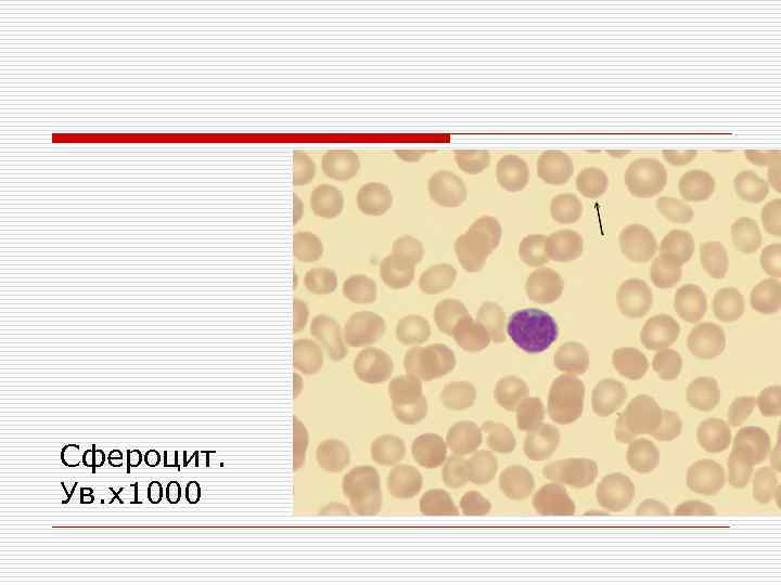 Сфероцит. Ув. х1000 