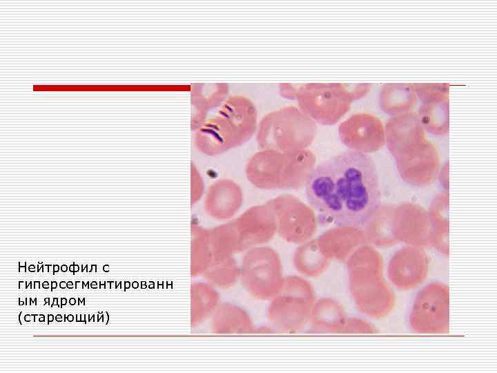 Нейтрофил с гиперсегментированн ым ядром (стареющий) 