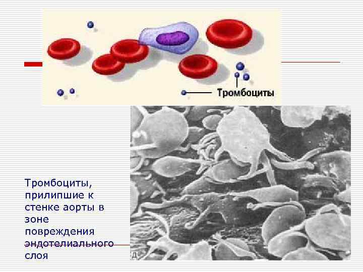 Тромбоциты, прилипшие к стенке аорты в зоне повреждения эндотелиального слоя 
