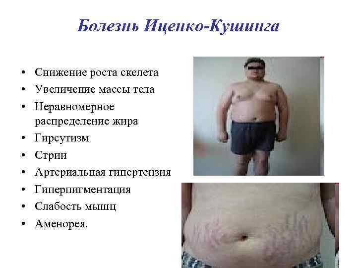 Болезнь Иценко-Кушинга • Снижение роста скелета • Увеличение массы тела • Неравномерное распределение жира