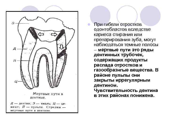 l При гибели отростков одонтобластов вследстве кариеса стирания или препарирования зуба, могут наблюдаться темные
