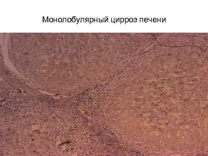 Монолобулярный цирроз печени 