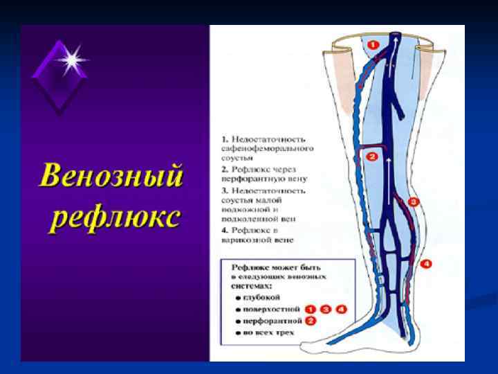 Рефлюкс вены нижних конечностей