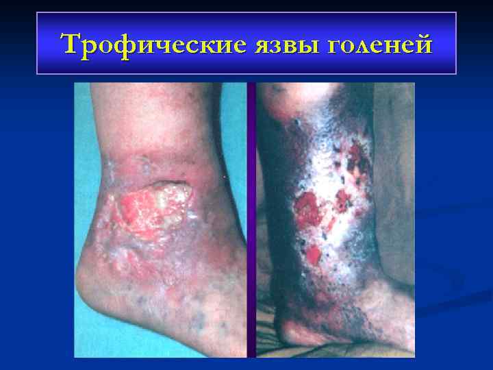Трофические язвы голеней 